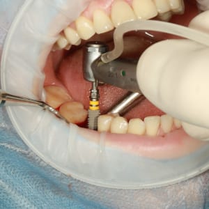 Dental implants in Poland