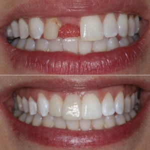 What is a dental bridge