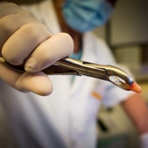 Dental extractions